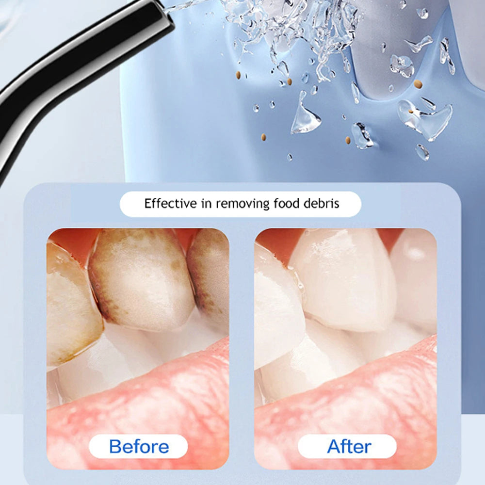 TonsiJet Water Flosser For Tonsil Stones