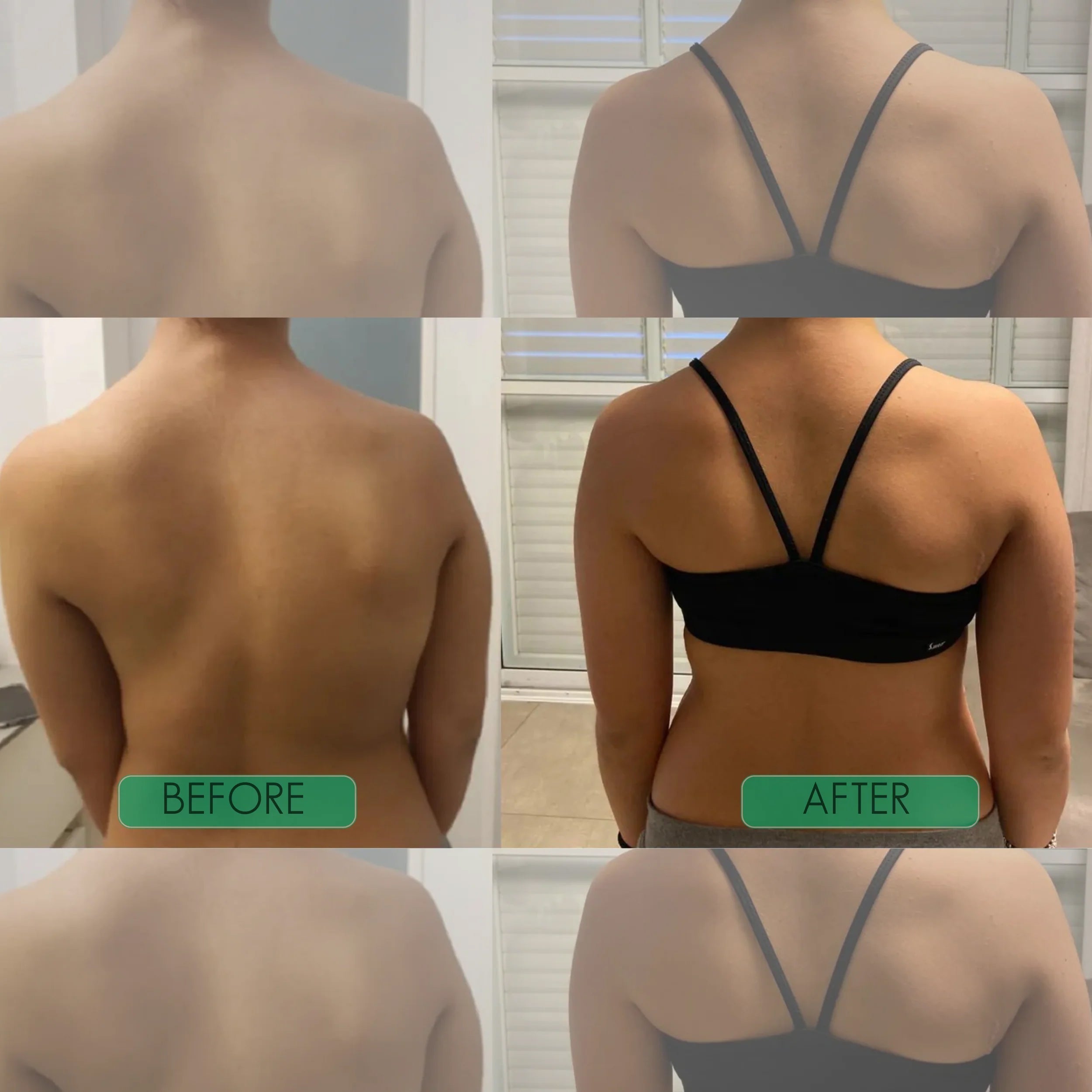 Postrixmer Posture Corrector